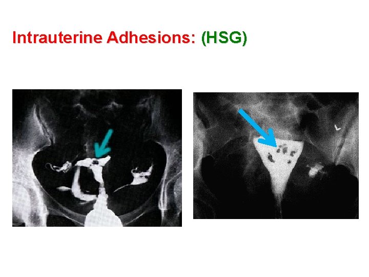 Intrauterine Adhesions: (HSG) 