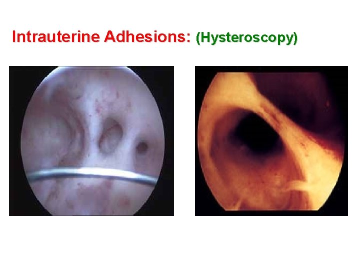 Intrauterine Adhesions: (Hysteroscopy) 