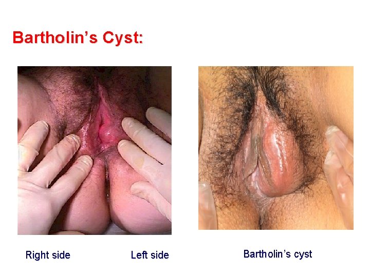 Bartholin’s Cyst: Right side Left side Bartholin’s cyst 