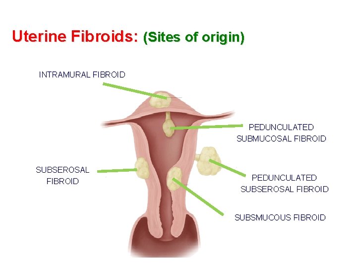 Uterine Fibroids: (Sites of origin) INTRAMURAL FIBROID PEDUNCULATED SUBMUCOSAL FIBROID SUBSEROSAL FIBROID PEDUNCULATED SUBSEROSAL
