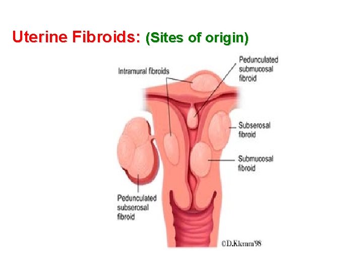 Uterine Fibroids: (Sites of origin) 