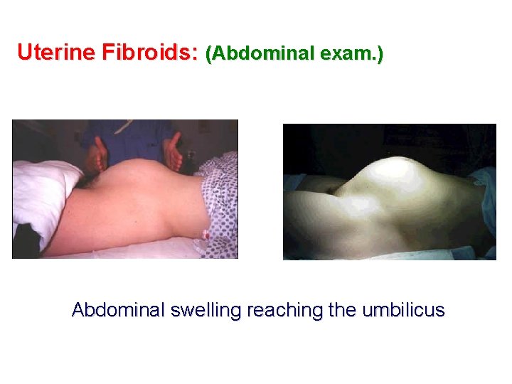 Uterine Fibroids: (Abdominal exam. ) Abdominal swelling reaching the umbilicus 