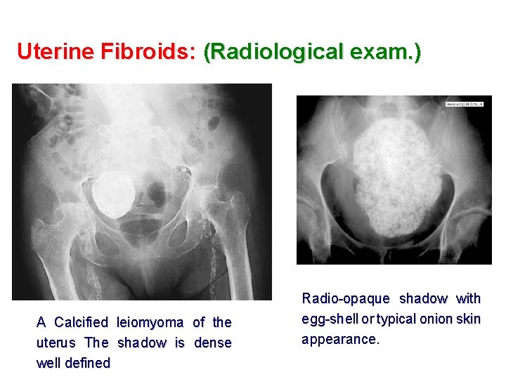 Uterine Fibroids: (Radiological exam. ) A Calcified leiomyoma of the uterus The shadow is