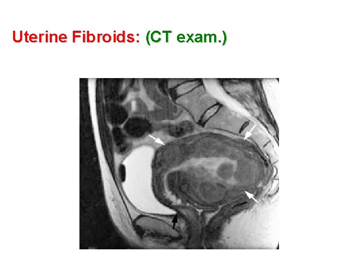 Uterine Fibroids: (CT exam. ) 