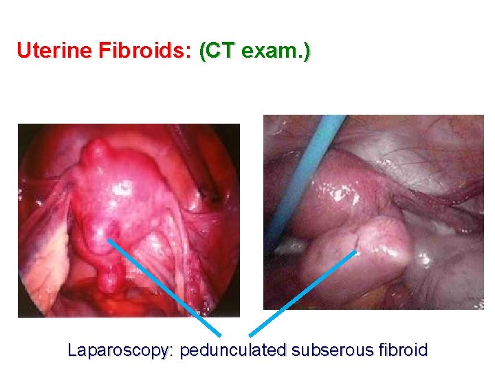 Uterine Fibroids: (CT exam. ) Laparoscopy: pedunculated subserous fibroid 