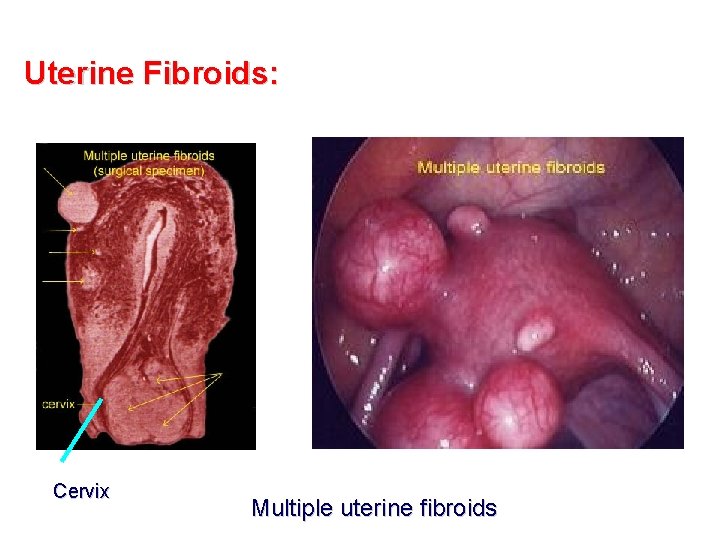 Uterine Fibroids: Cervix Multiple uterine fibroids 