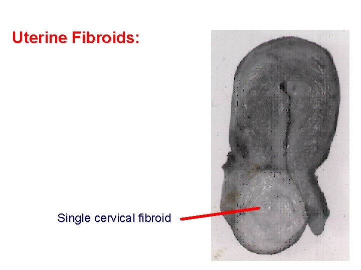 Uterine Fibroids: Single cervical fibroid 