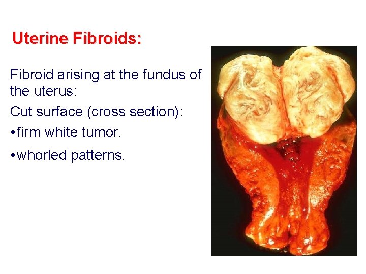 Uterine Fibroids: Fibroid arising at the fundus of the uterus: Cut surface (cross section):