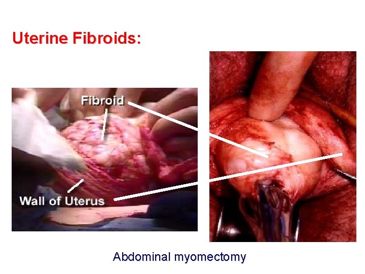 Uterine Fibroids: Abdominal myomectomy 