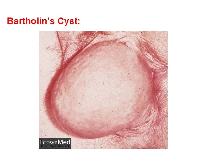 Bartholin’s Cyst: 