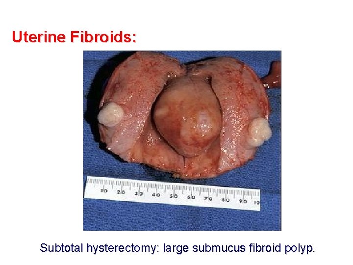 Uterine Fibroids: Subtotal hysterectomy: large submucus fibroid polyp. 