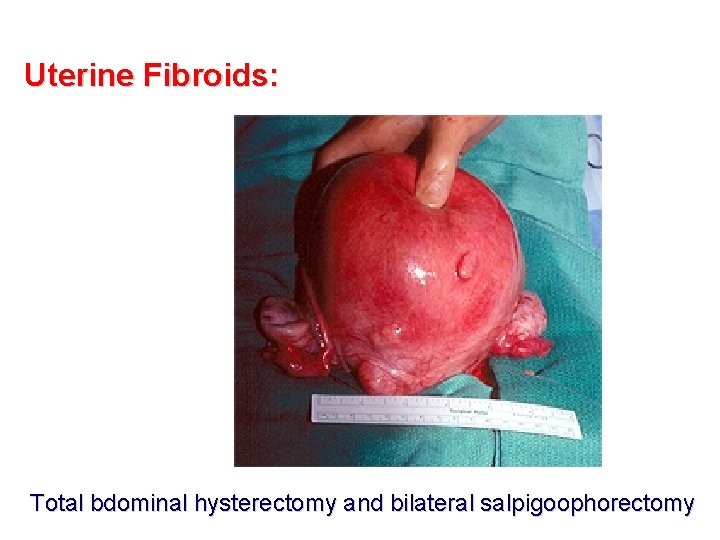 Uterine Fibroids: Total bdominal hysterectomy and bilateral salpigoophorectomy 