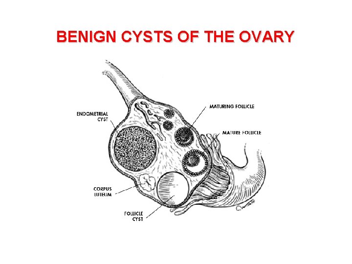 BENIGN CYSTS OF THE OVARY 