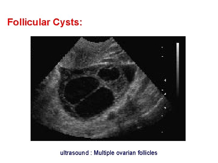 Follicular Cysts: ultrasound : Multiple ovarian follicles 
