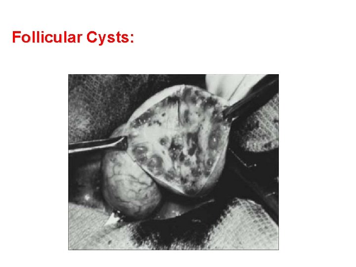 Follicular Cysts: 