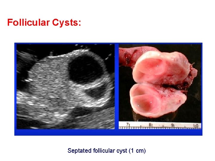 Follicular Cysts: Septated follicular cyst (1 cm) 