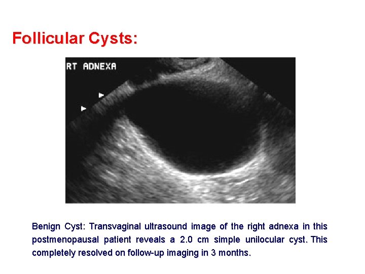 Follicular Cysts: Benign Cyst: Transvaginal ultrasound image of the right adnexa in this postmenopausal