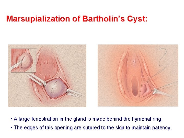Marsupialization of Bartholin’s Cyst: • A large fenestration in the gland is made behind