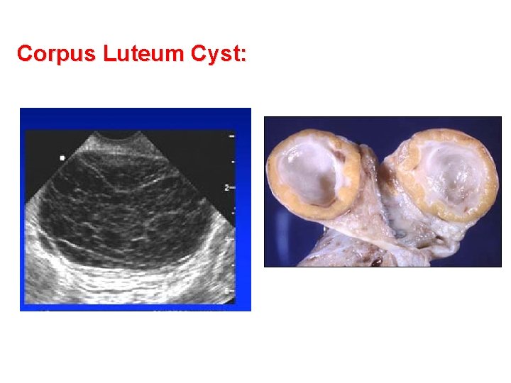 Corpus Luteum Cyst: 