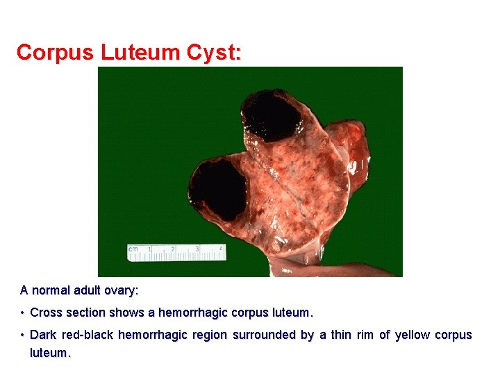 Corpus Luteum Cyst: A normal adult ovary: • Cross section shows a hemorrhagic corpus