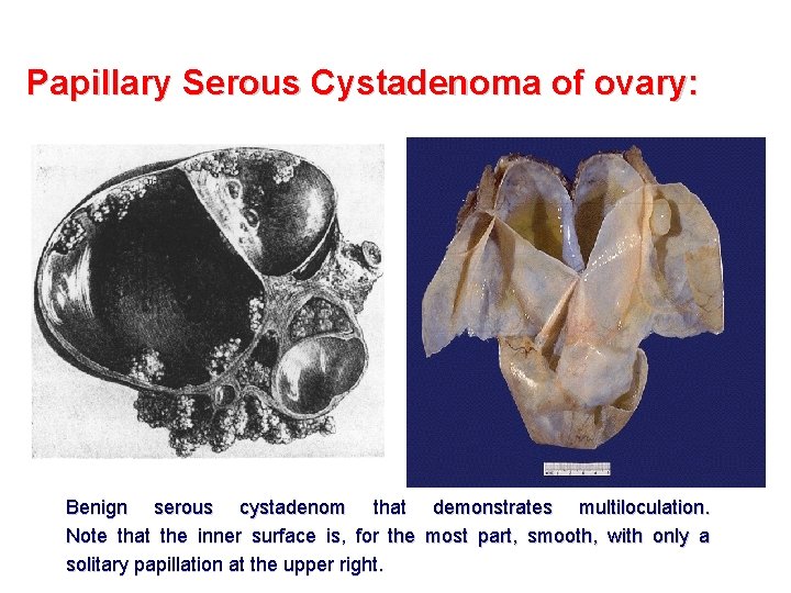 Papillary Serous Cystadenoma of ovary: Benign serous cystadenom that demonstrates multiloculation. Note that the