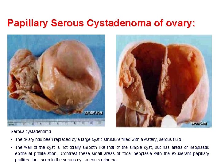 Papillary Serous Cystadenoma of ovary: Serous cystadenoma • The ovary has been replaced by