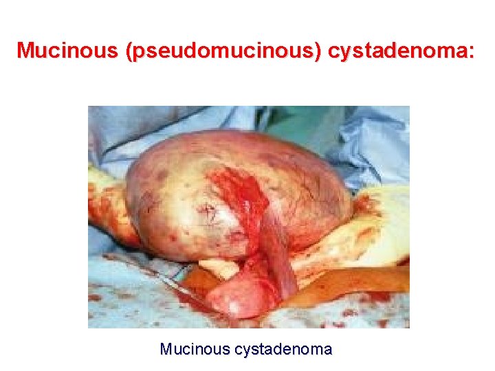 Mucinous (pseudomucinous) cystadenoma: Mucinous cystadenoma 