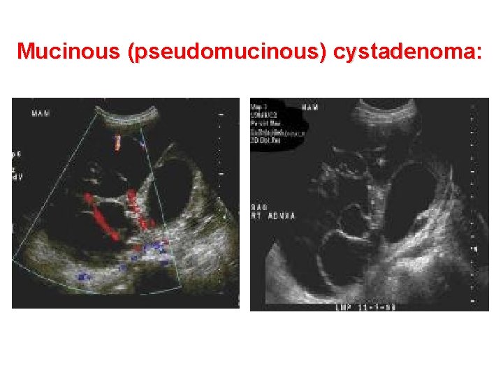 Mucinous (pseudomucinous) cystadenoma: 