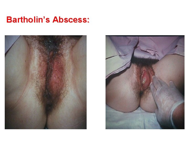Bartholin’s Abscess: 