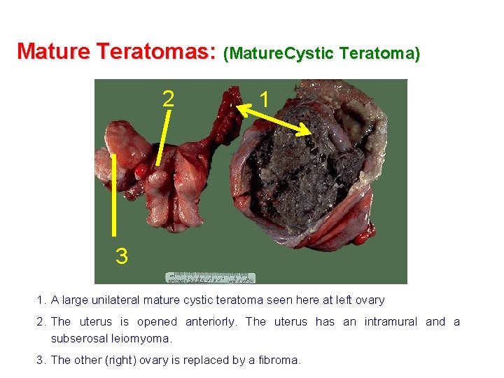 Mature Teratomas: (Mature. Cystic Teratoma) 2 1 3 1. A large unilateral mature cystic