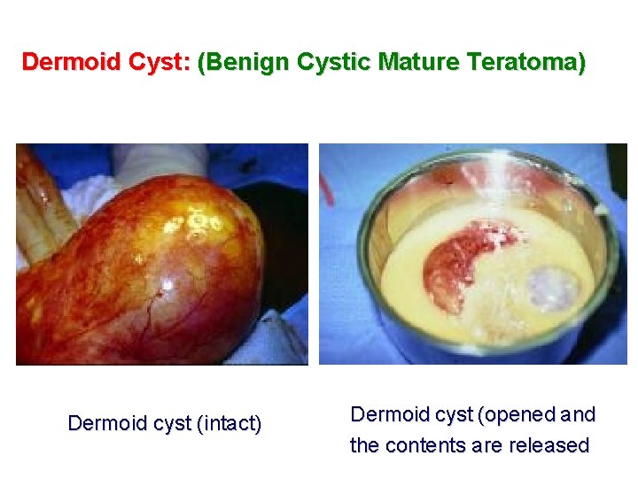 Dermoid Cyst: (Benign Cystic Mature Teratoma) Dermoid cyst (intact) Dermoid cyst (opened and the