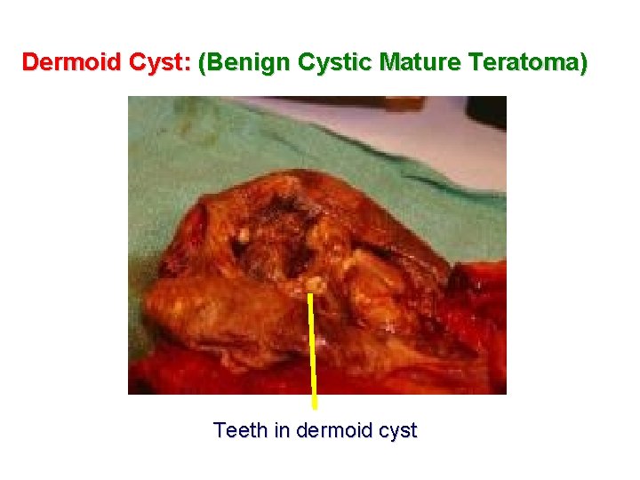 Dermoid Cyst: (Benign Cystic Mature Teratoma) Teeth in dermoid cyst 