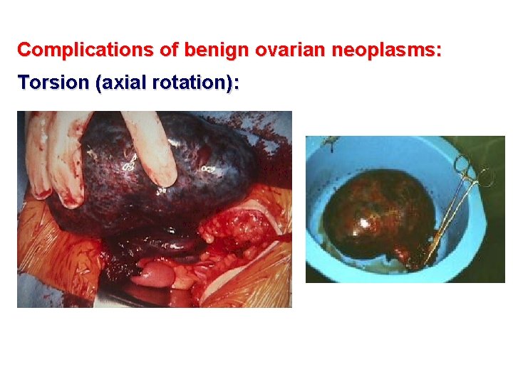 Complications of benign ovarian neoplasms: Torsion (axial rotation): 