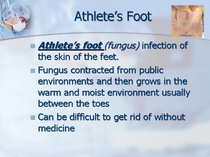 Athlete’s Foot n Athlete’s foot (fungus) infection of the skin of the feet. n