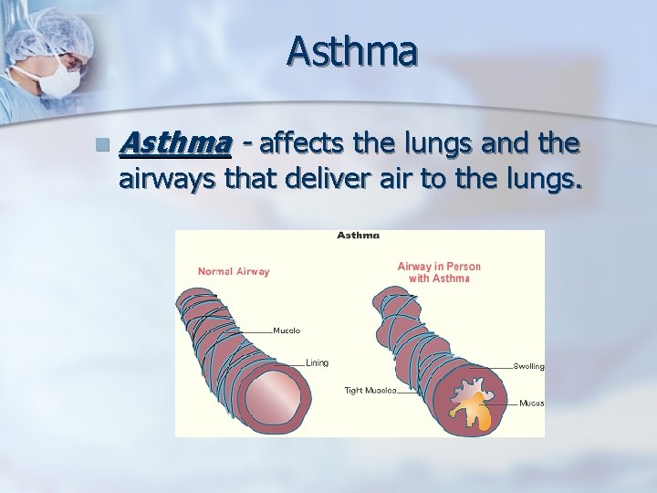Asthma n Asthma - affects the lungs and the airways that deliver air to