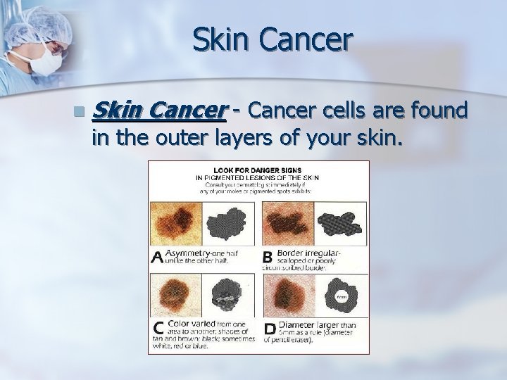 Skin Cancer n Skin Cancer - Cancer cells are found in the outer layers