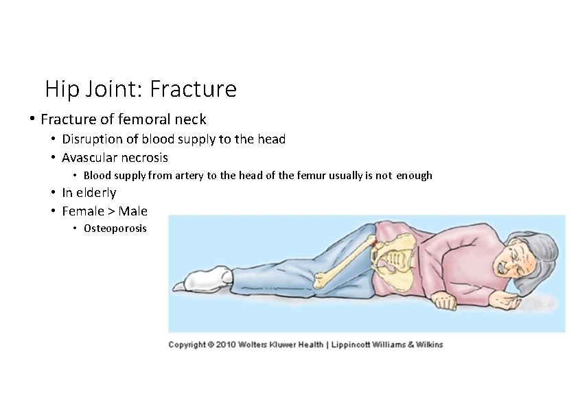 Hip Joint: Fracture • Fracture of femoral neck • Disruption of blood supply to