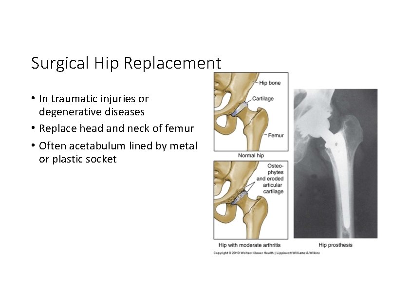 Surgical Hip Replacement • In traumatic injuries or degenerative diseases • Replace head and