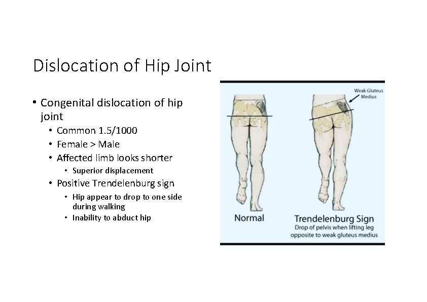 Dislocation of Hip Joint • Congenital dislocation of hip joint • Common 1. 5/1000