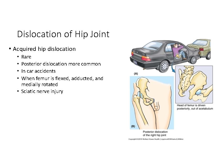 Dislocation of Hip Joint • Acquired hip dislocation Rare Posterior dislocation more common In