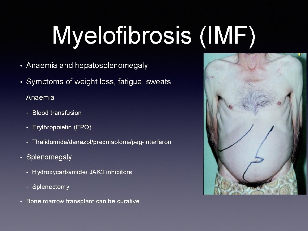 Myelofibrosis (IMF) • Anaemia and hepatosplenomegaly • Symptoms of weight loss, fatigue, sweats •
