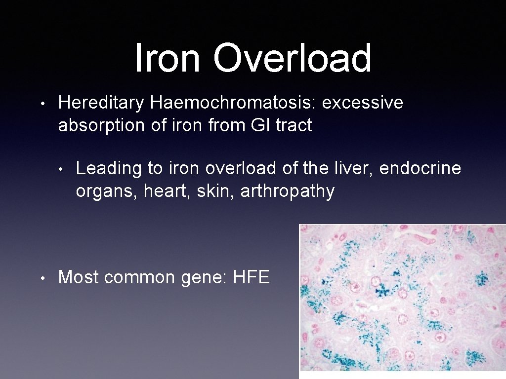 Iron Overload • Hereditary Haemochromatosis: excessive absorption of iron from GI tract • •