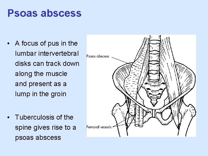 Psoas abscess • A focus of pus in the lumbar intervertebral disks can track