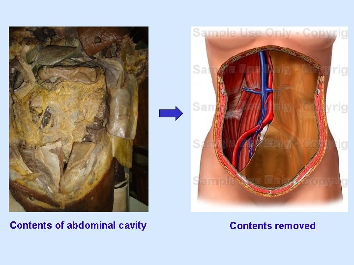 Contents of abdominal cavity Contents removed 