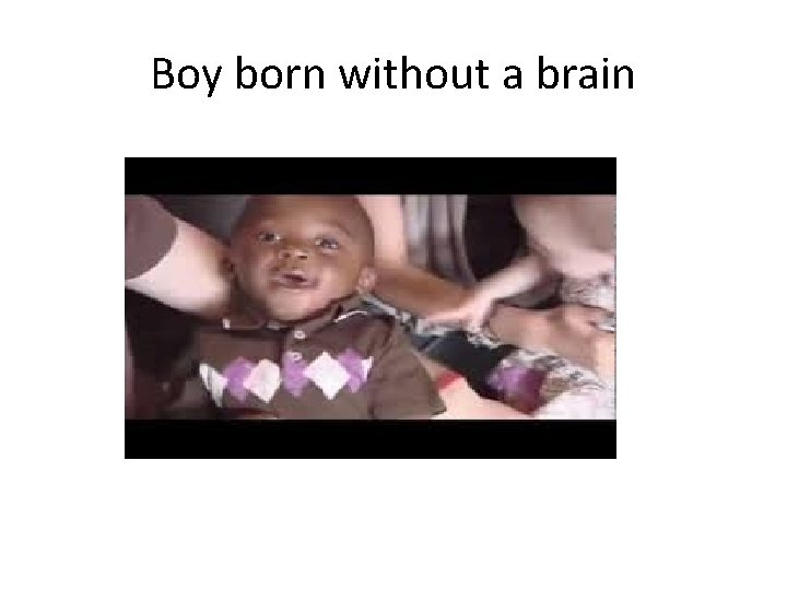 Boy born without a brain 