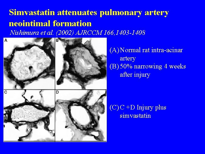 Simvastatin attenuates pulmonary artery neointimal formation Nishimura et al. (2002) AJRCCM 166, 1403 -1408