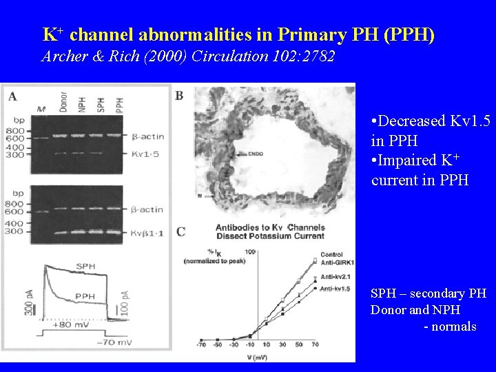 K+ channel abnormalities in Primary PH (PPH) Archer & Rich (2000) Circulation 102: 2782