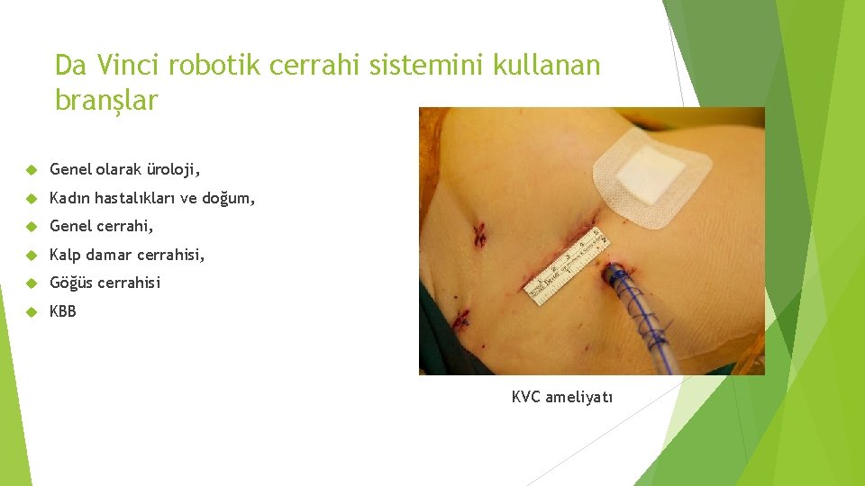 Da Vinci robotik cerrahi sistemini kullanan branşlar Genel olarak üroloji, Kadın hastalıkları ve doğum,