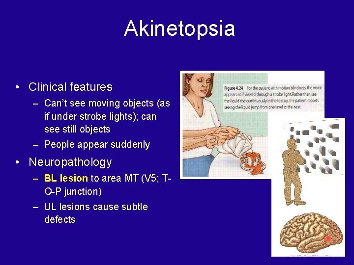 Akinetopsia • Clinical features – Can’t see moving objects (as if under strobe lights);