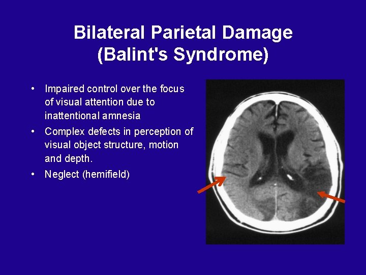 Bilateral Parietal Damage (Balint's Syndrome) • Impaired control over the focus of visual attention